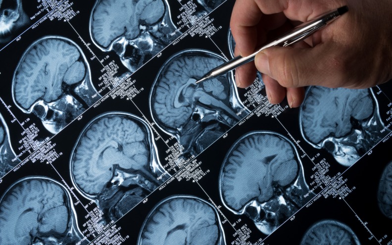 Odobren novi lijek za Alzheimerovu bolest: ‘Današnje vijesti su nevjerojatno važne’